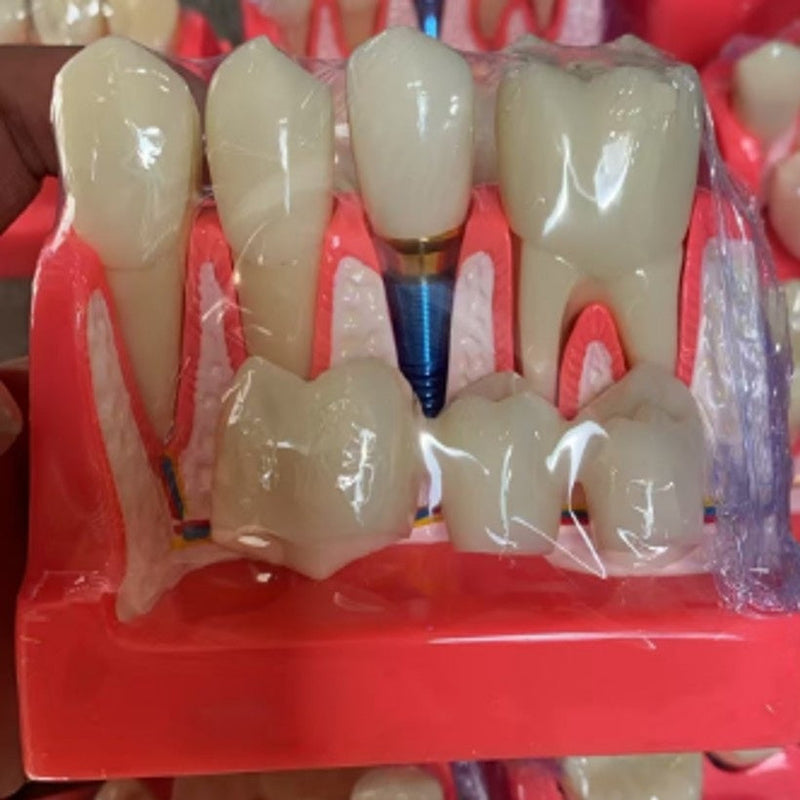 Veneer Dental Implant Model Veneer Dental Implant Model