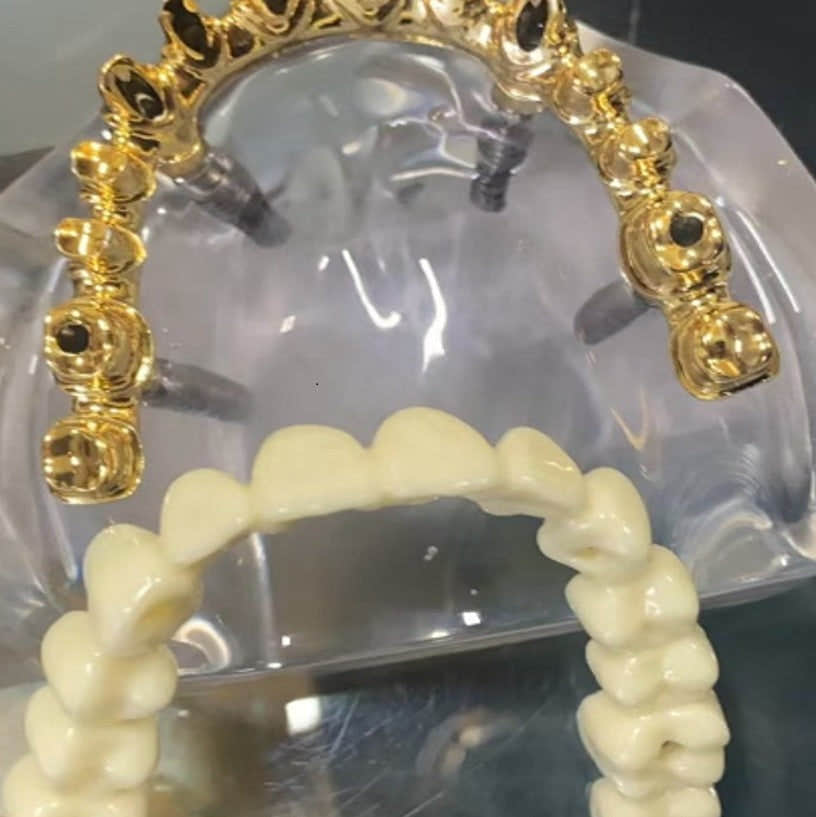 Aesthetic Bridge 4 Implant Aesthetic Bridge 4 Implant