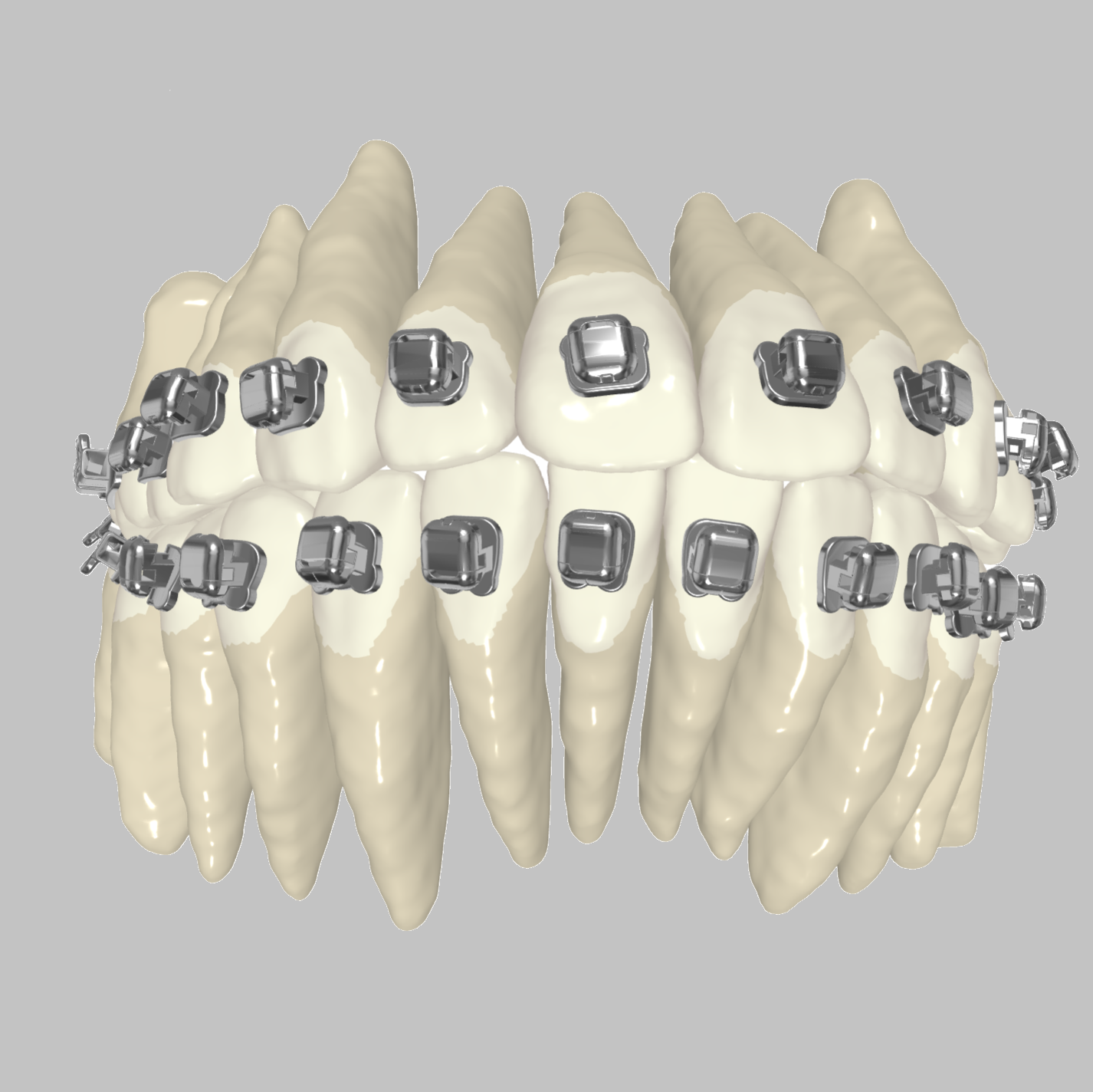 Custom Braces - as easy as clear aligners! Custom Braces - as easy as clear aligners!