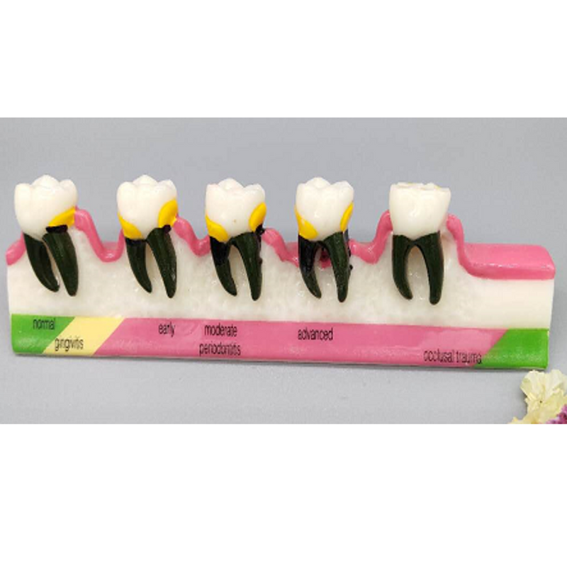 Periodontal Disease Model Periodontal Disease Model