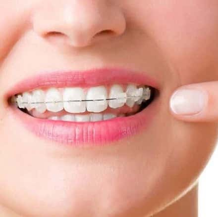 Custom Braces - as easy as clear aligners! Custom Braces - as easy as clear aligners!