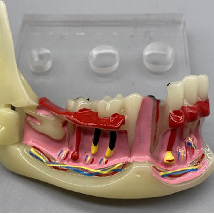 Mandibular Pathological Model Mandibular Pathological Model