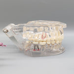 Transparent pathological tooth model Transparent pathological tooth model