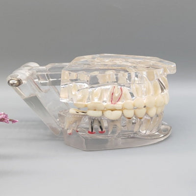 Transparent pathological tooth model Transparent pathological tooth model
