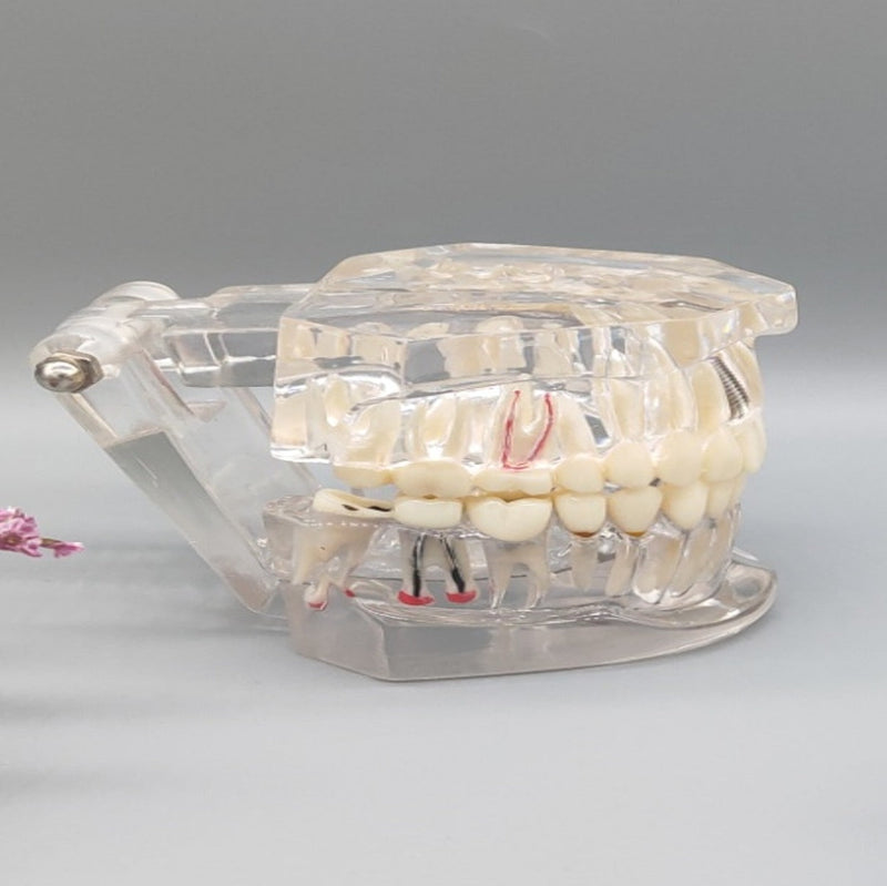 Transparent pathological tooth model Transparent pathological tooth model