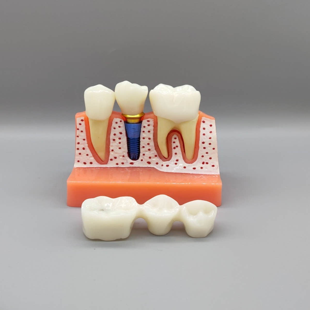 Dental Implant Educational Model (Copy) Dental Implant Educational Model (Copy)
