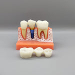 Dental Implant Educational Model (Copy) Dental Implant Educational Model (Copy)