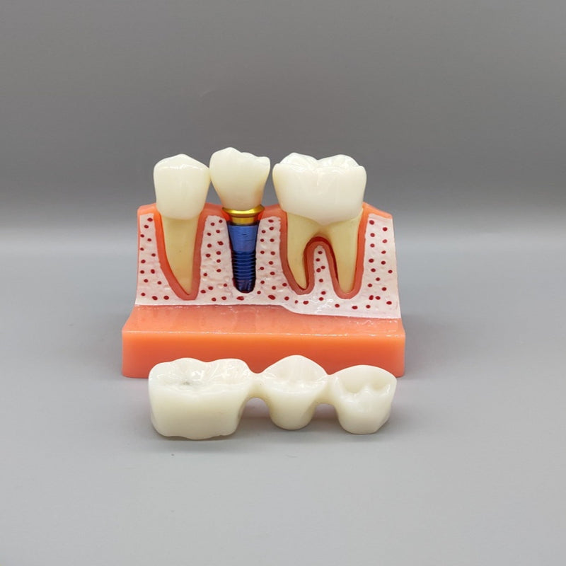 Dental Implant Educational Model (Copy) Dental Implant Educational Model (Copy)