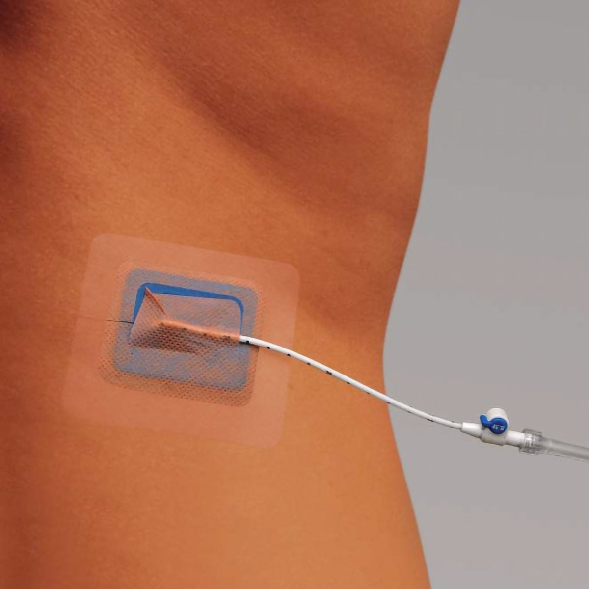 Stayfix Catheter Fixation Device - 721441_BX - 1 Stayfix Catheter Fixation Device - 721441_BX - 2