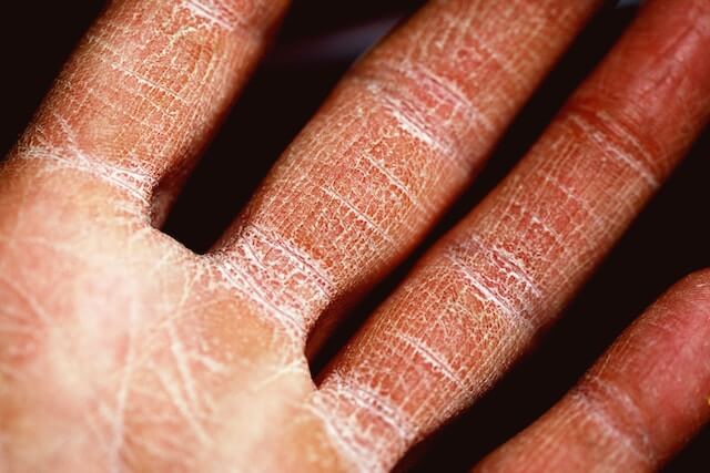 person with diabetes has dry skin on their hands