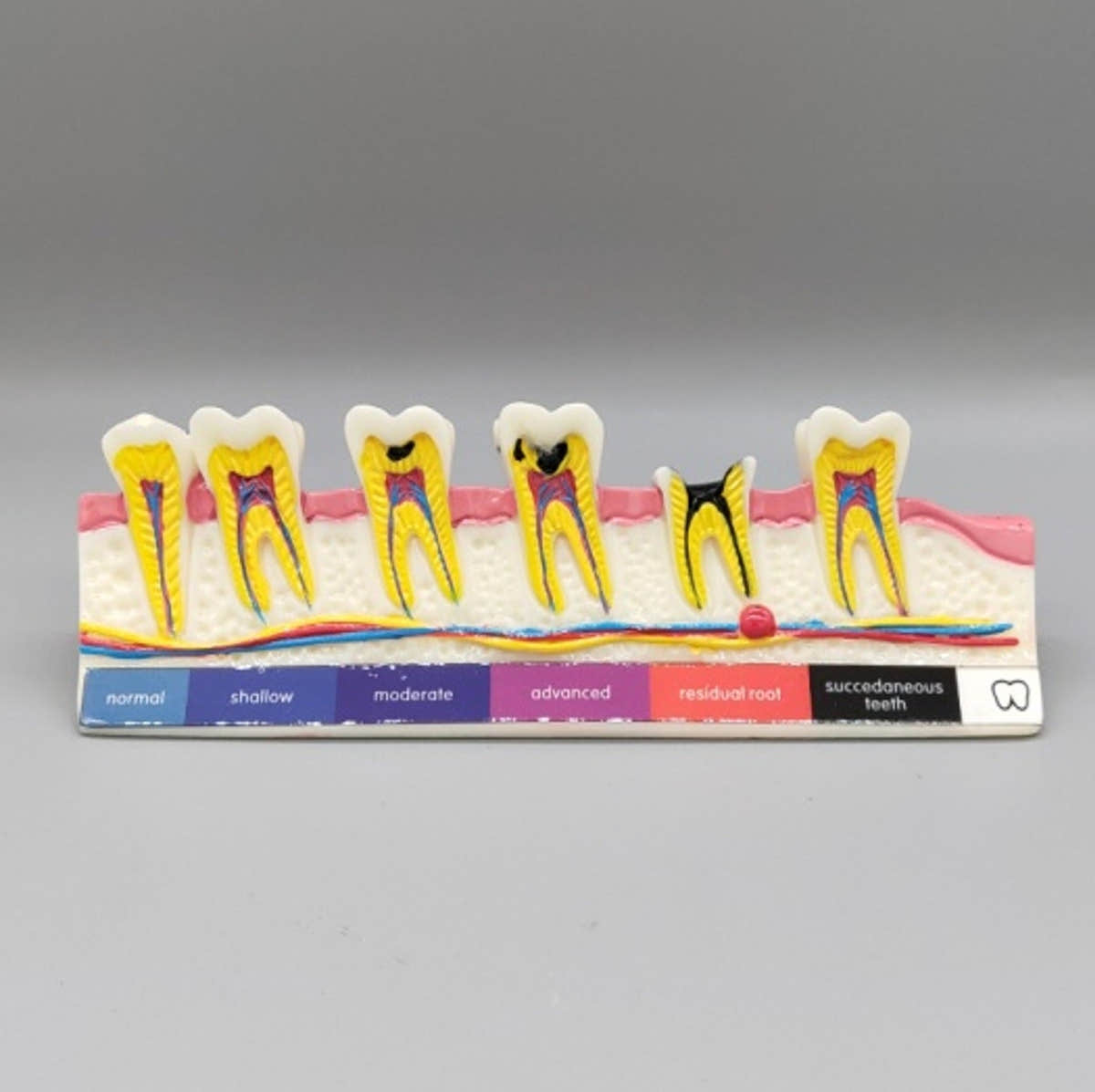 Tooth Caries Model