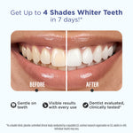 Whitening Strips