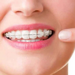 Custom Braces - as easy as clear aligners!