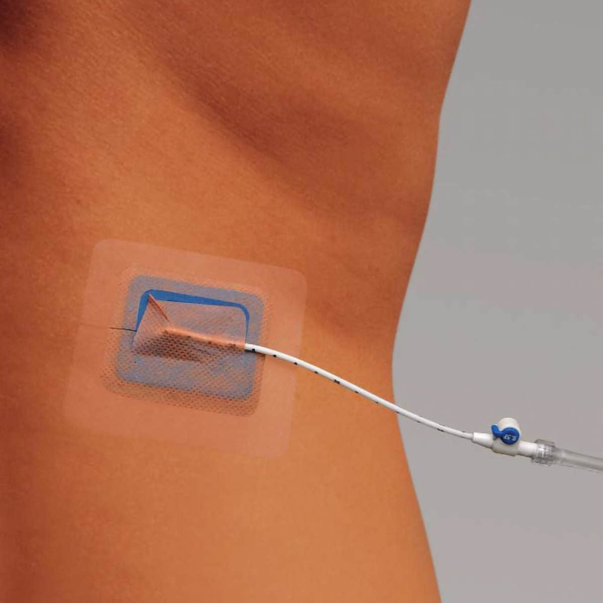 Stayfix Catheter Fixation Device - 721441_BX - 2